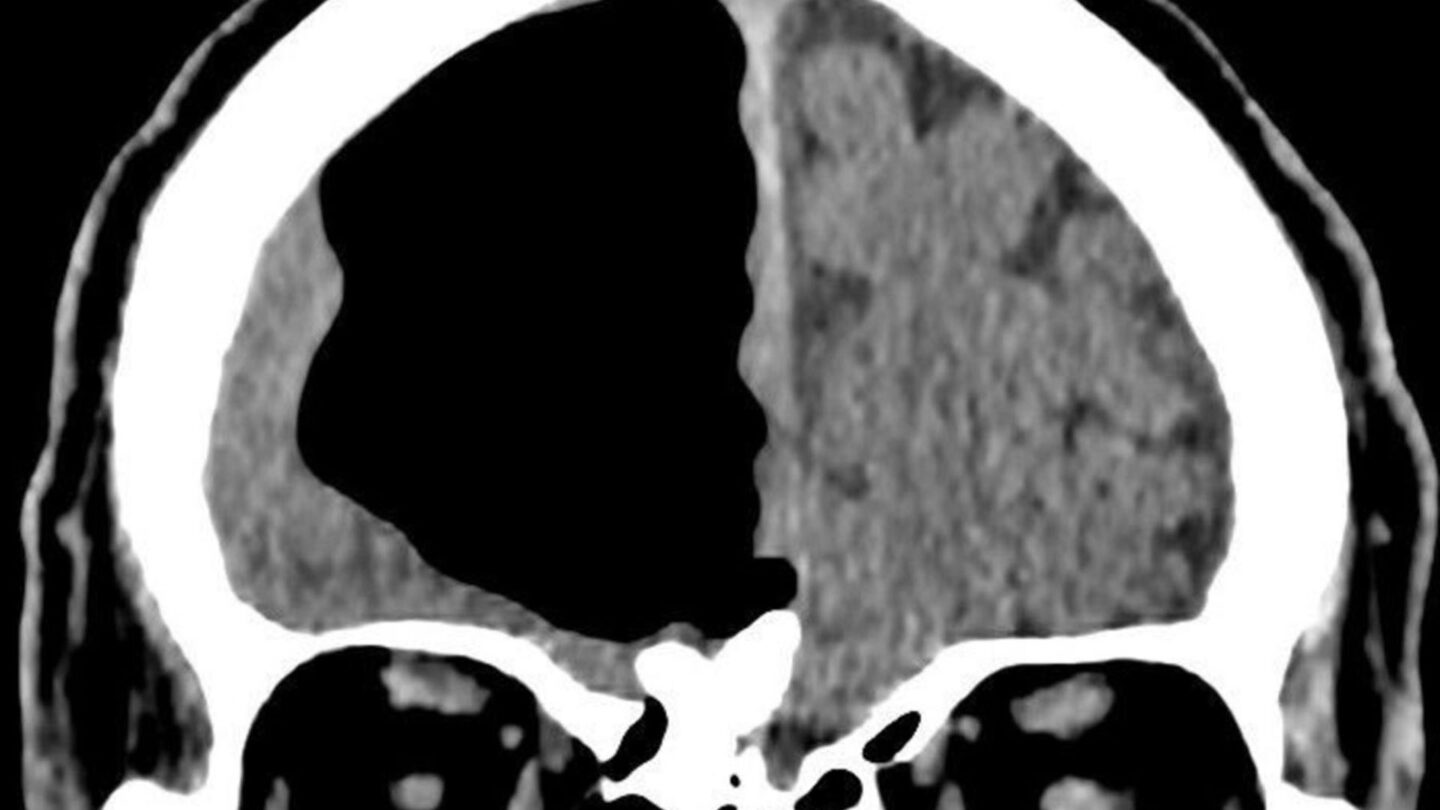 Un médico halló un hueco de aire donde debía estar el cerebro de un hombre |