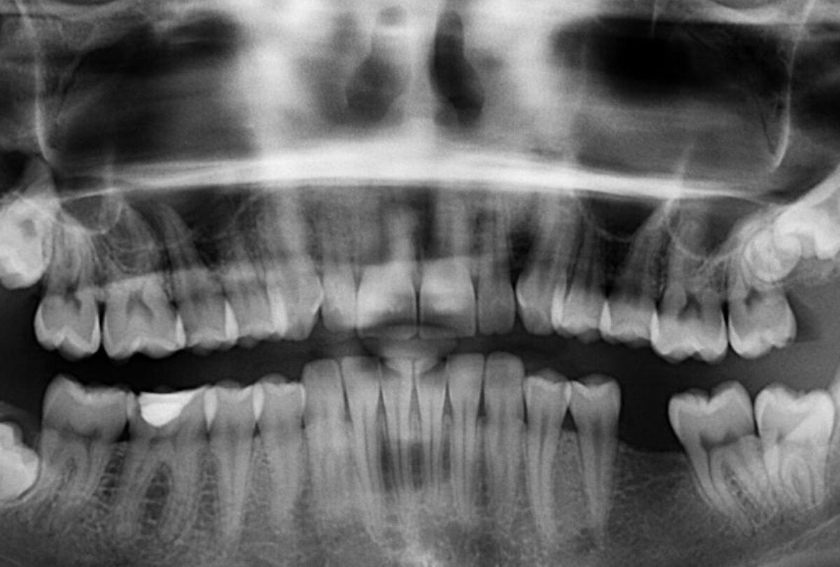 x ray 961977 1920 crop1614552046065jpg 1199923512 Qué significa soñar que se te caen los dientes y muelas |