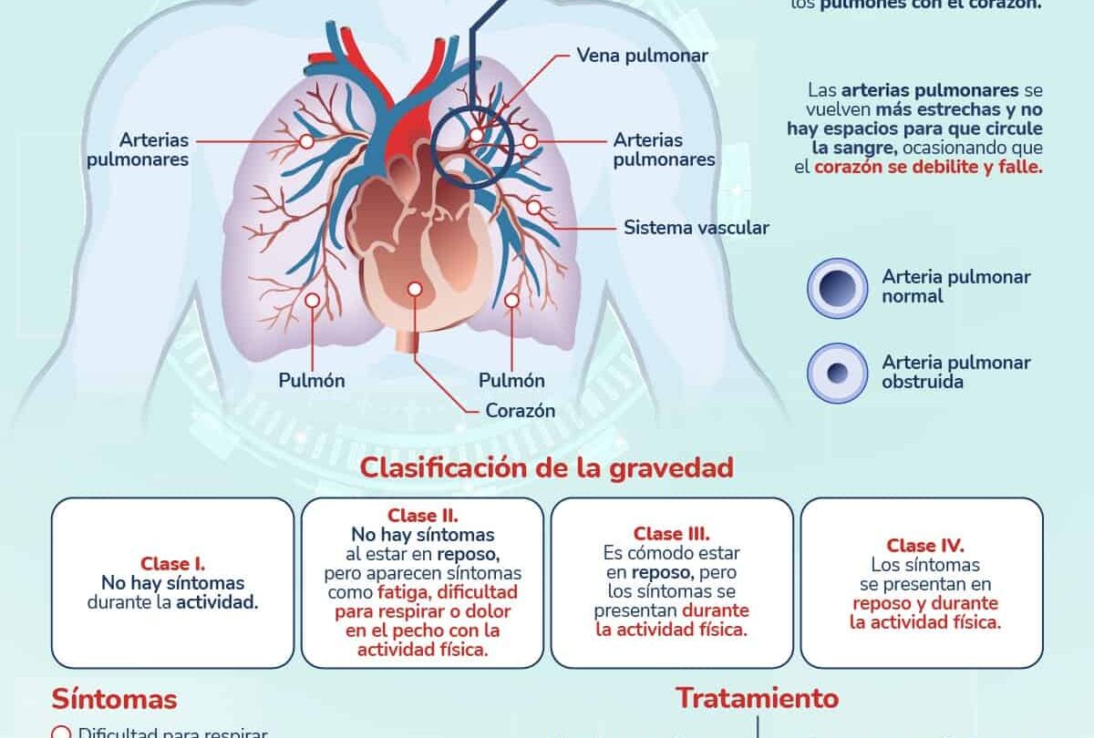senalan cuidados para prevenir hipertension pulmonar SEÑALAN CUIDADOS PARA PREVENIR HIPERTENSIÓN PULMONAR |