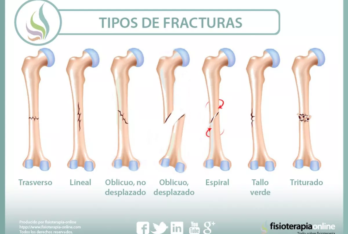 fractura o division de tareas Fractura o división de tareas |