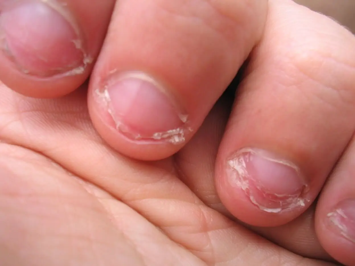 Morderse las uñas causas y consecuencias | México Ahora En la mayoría de los casos las personas se muerden las uñas por ansiedad estrés nerviosismo o aburrimiento Es una conducta repetitiva que funciona como mecanismo inconsciente para liberar tensión