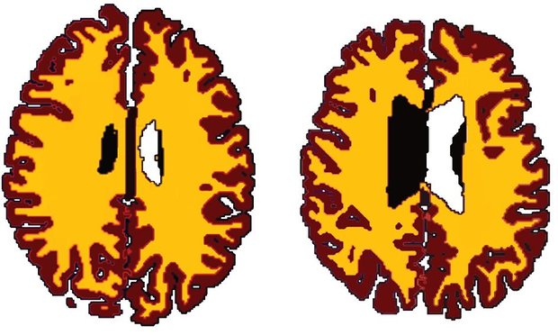 El cerebro de una persona con sobrepeso luce diez años mayor que el de alguien con peso normal