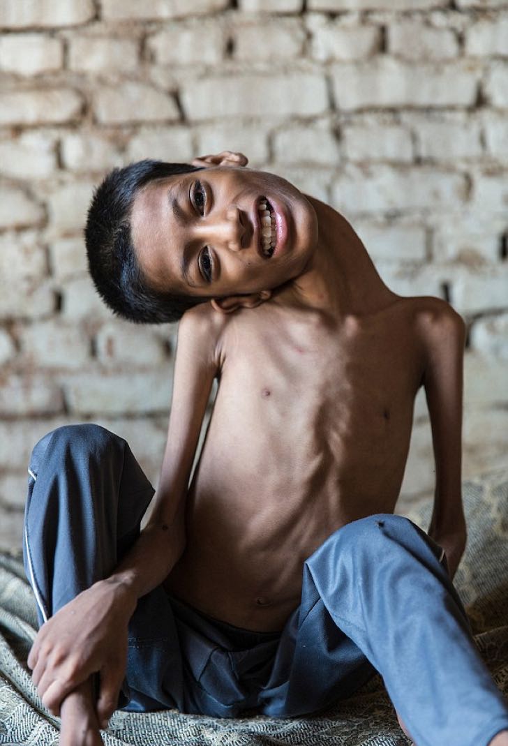 Niño que se hizo famoso por su extraña condición en el cuello, al fin pudo mirar la vida normalmente