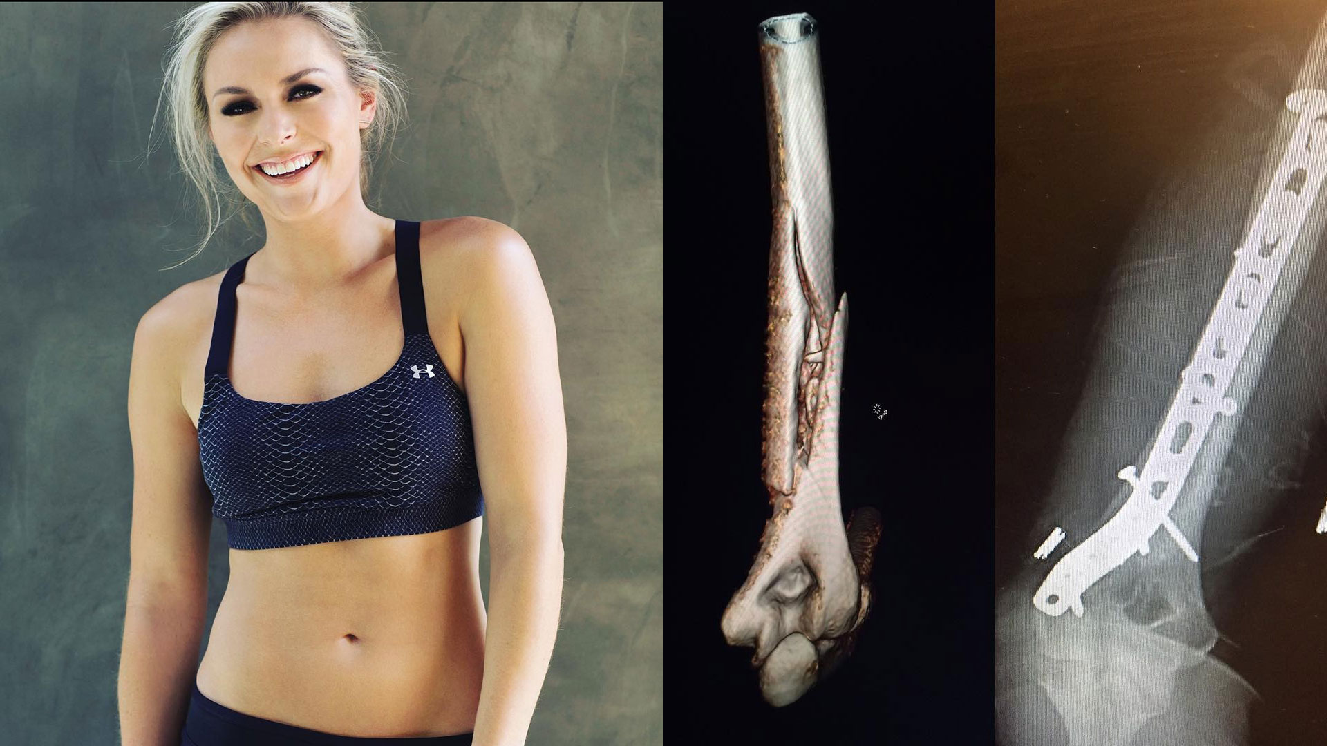 Así quedó el brazo de la esquiadora Lindsey Vonn, luego de sufrir un terrible accidente