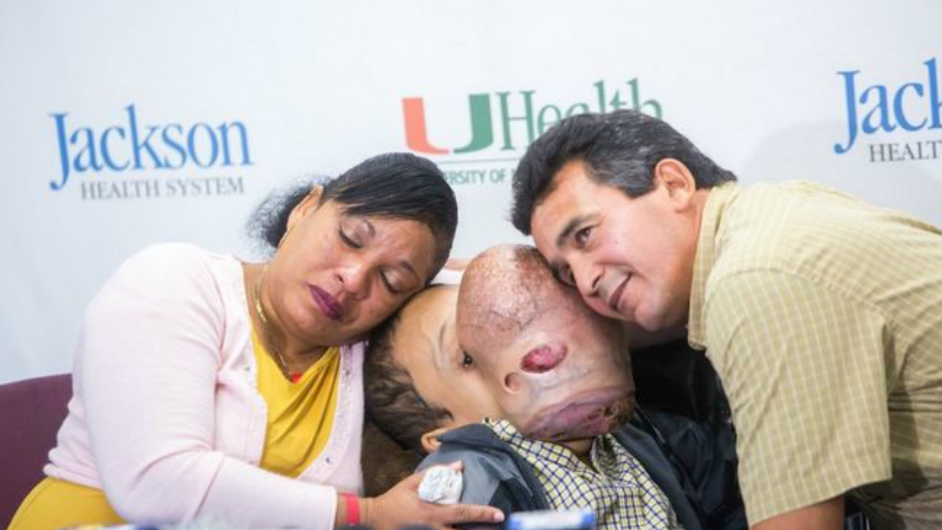 Murió Emanuel, el niño cubano al que le extirparon un tumor facial de 4,5 kilos en Miami