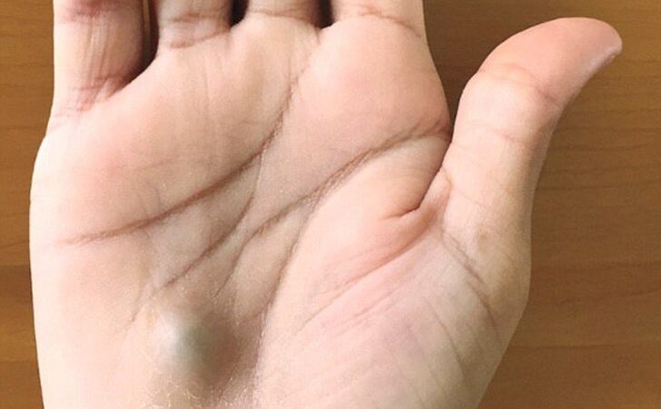 Fue al dentista y un bulto morado apareció en su mano. Estaba a punto de morir y jamás lo sospechó