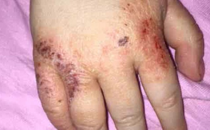 Sufrió psoriasis por años. Aplicó crema de bebé de 4 dólares y 1 día después su piel luce perfecta