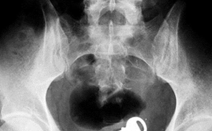24 radiografías de cosas que los doctores han encontrado en el trasero (y otras partes) de las personas
