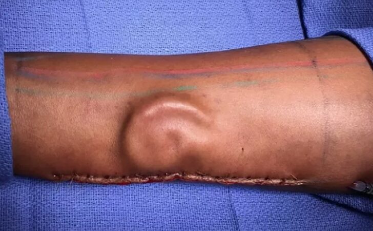 Una oreja crece en el brazo de una víctima. Pronto la tendrá en su cabeza y la sentirá como propia