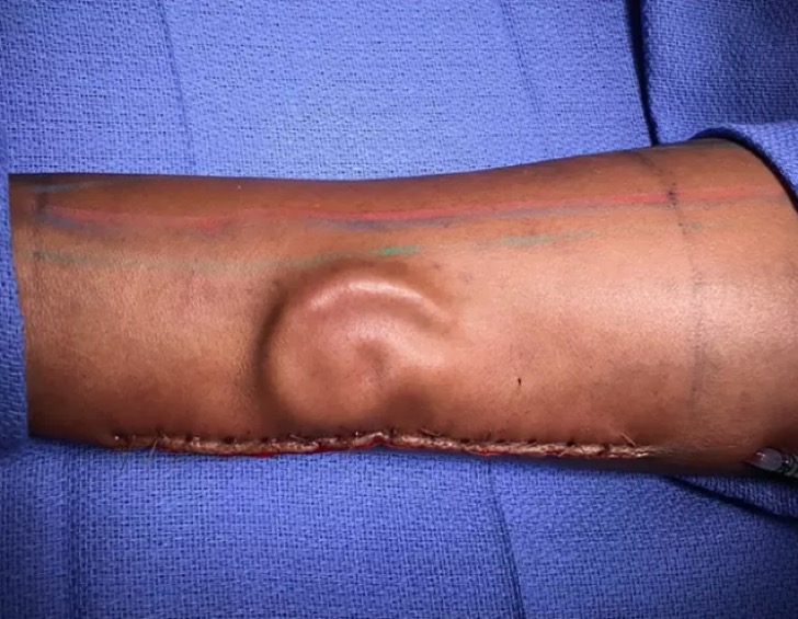 Una oreja crece en el brazo de una víctima. Pronto la tendrá en su cabeza y la sentirá como propia