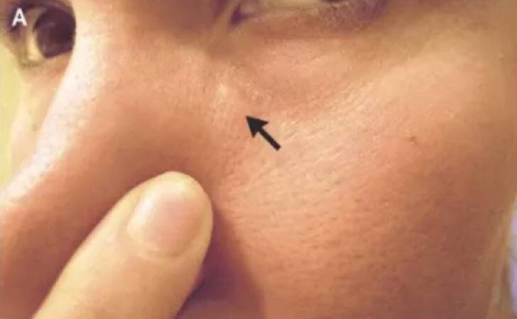 El bulto partió en el ojo y terminó en el labio. Le confirmaron que un gusano se movía bajo su piel