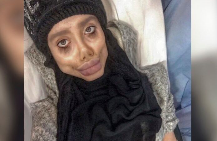 Así era el rostro de ‘Angelina Jolie zombie’ antes de operarse