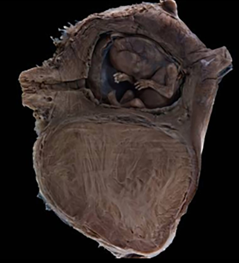 En esta muestra se observa un fibroma uterino junto con un feto (Michael Frank)