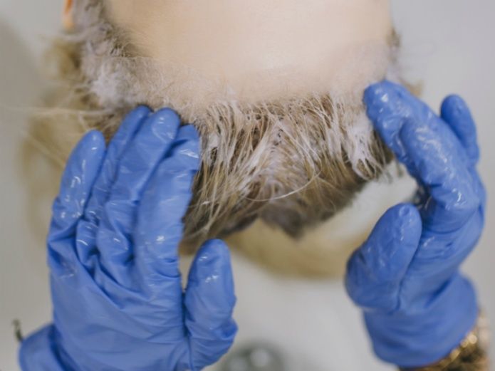 Joven se tiñe el pelo y una alergia deforma su rostro