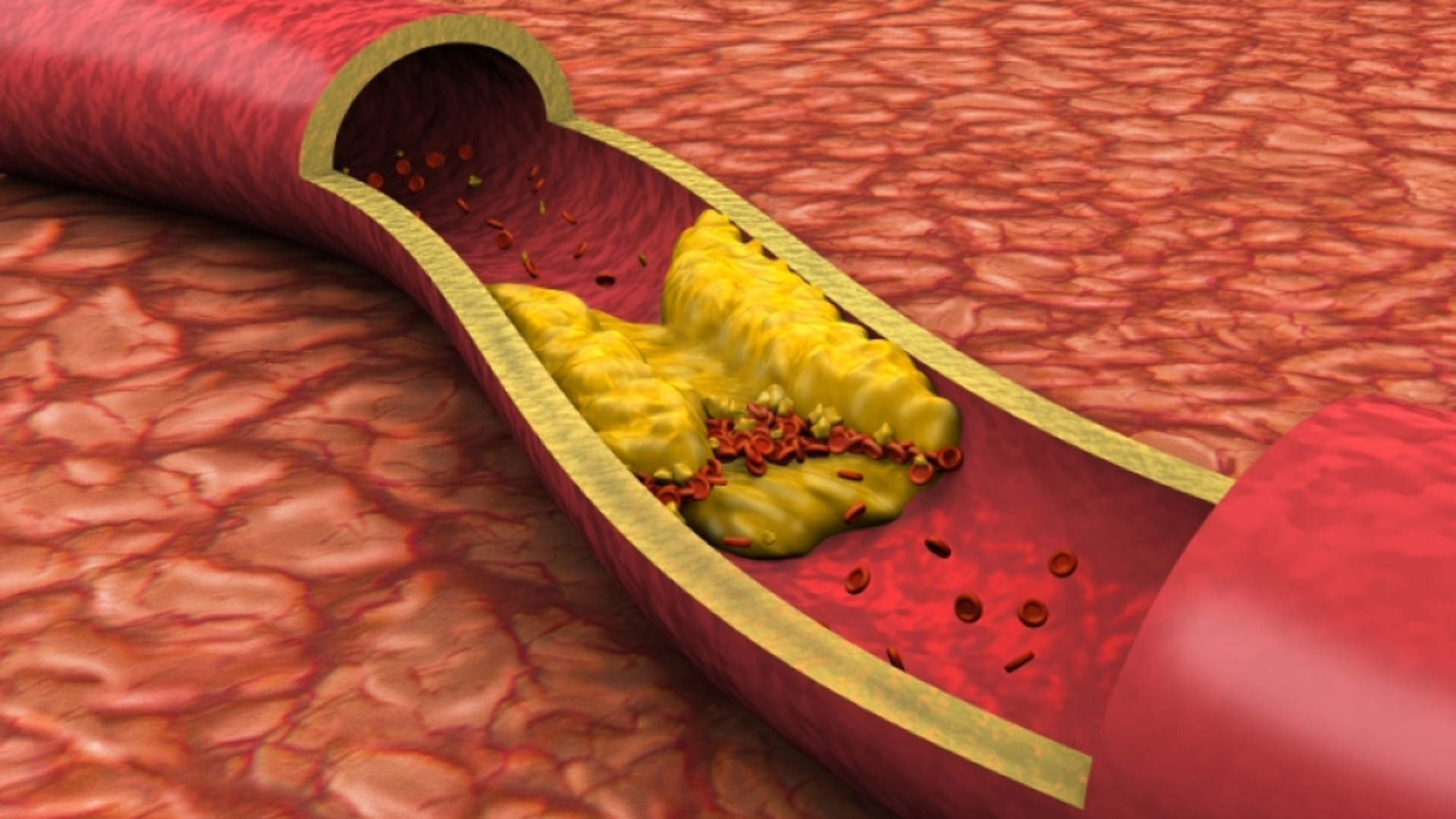 La acumulación de placas de colesterol en las arterias puede generar una obstrucción y un posterior infarto. Puede ingresar al organismo a través de dos vías: una interna, generada por el hígado y otra externa, a través de los alimentos de origen animal como la carne y los productos lácteos que ingerimos.