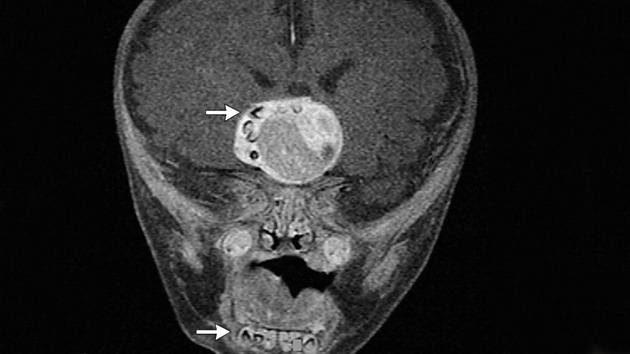 A niño le extraen dientes del ‘CEREBRO’ todo esto por un dolor de cabeza