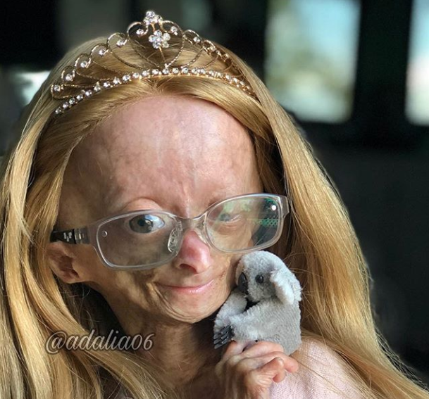 Adalia Rose, la pequeña youtuber con envejecimiento prematuro que conquistó a millones de seguidores