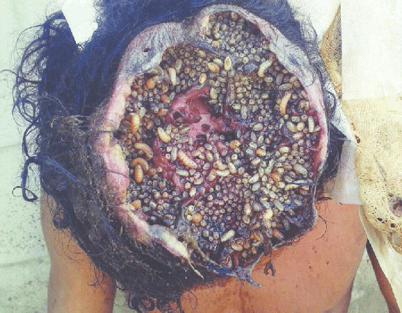 Murió de forma fea un joven que tenia larvas en la cabeza