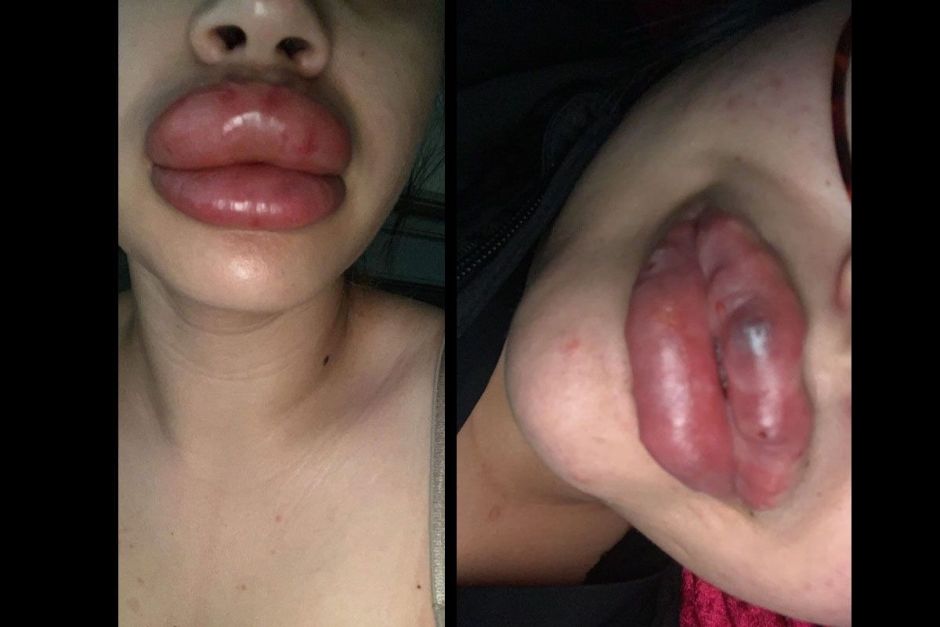 Inyecciones baratas en los labios le cuestan ‘muy’ caro a siete mujeres en Arizona