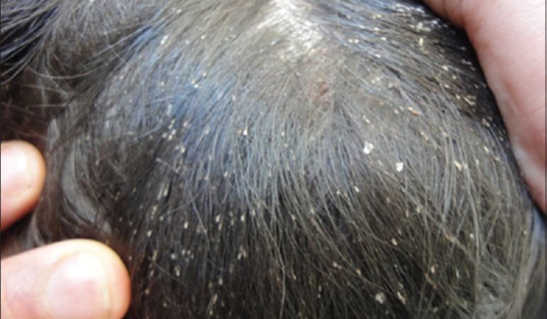 Alerta en Naucalpan por contagio masivo de piojos