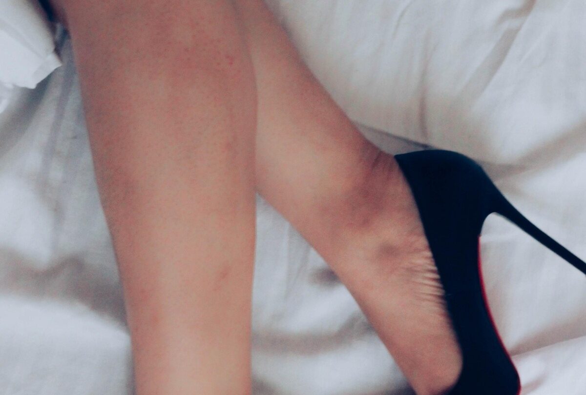 Qué puedes hacer para eliminar las varices |