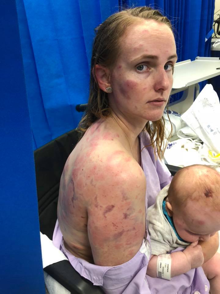 Mujer cubrió con su cuerpo a su bebé del granizo en Australia
