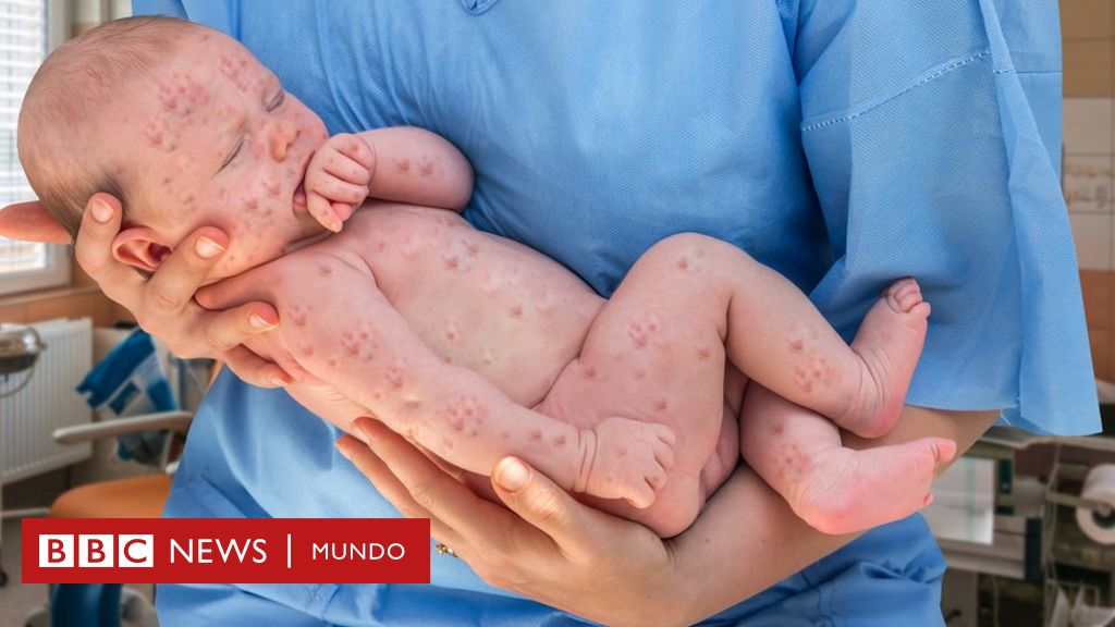 Otro brote de sarampión en EE.UU. es el nuevo y triste triunfo de los antivacunas