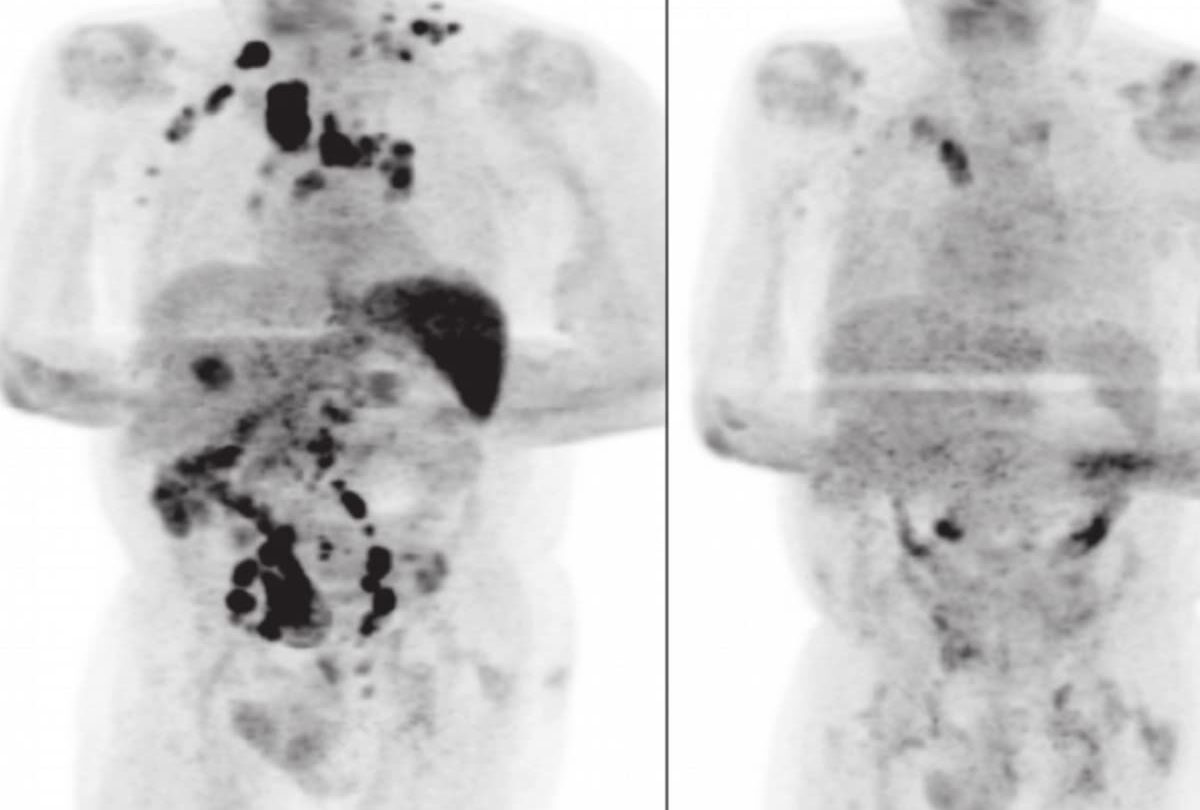 Paciente se cura de cáncer linfático tras contagiarse de COVID 19 |