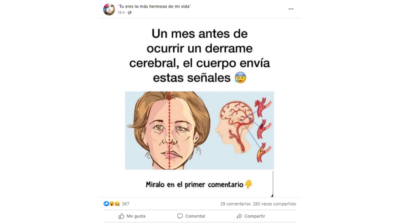 Señales de que estás en riesgo de sufrir un derrame cerebral