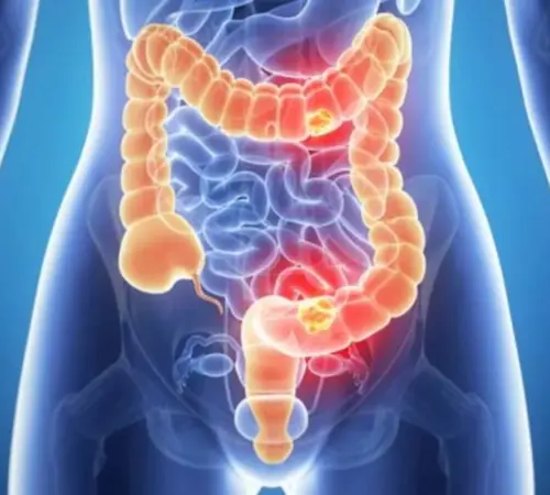 Hemorroides: causas comunes, síntomas y cómo prevenirlas