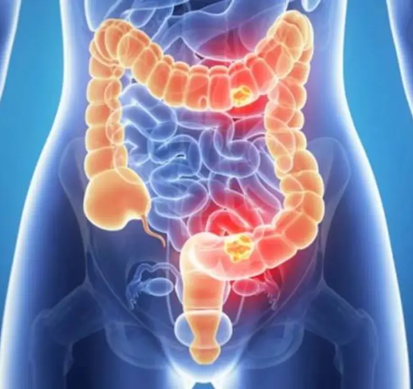 Hemorroides: causas comunes, síntomas y cómo prevenirlas