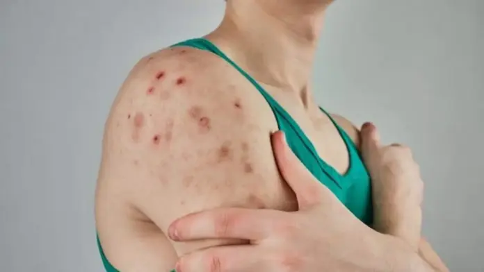 Sarampión en Edomex: cubrebocas obligatorio en escuelas desde el 9 de febrero