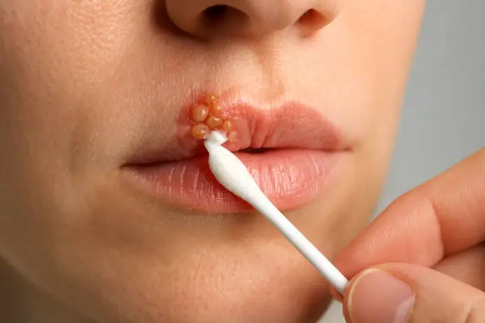 Fuego labial en labios mostrando ampollas características y tratamiento con crema antiviral
