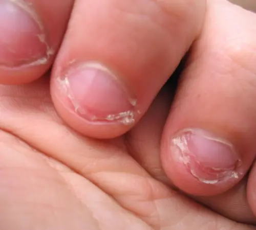 Morderse las uñas: causas y consecuencias