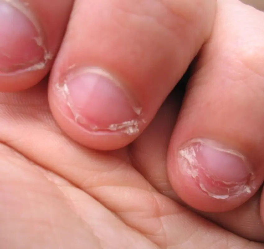 Morderse las uñas: causas y consecuencias