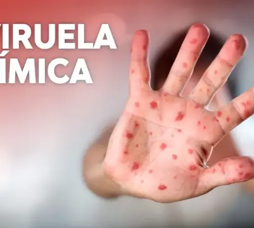 Viruela símica en México: aumento de contagios y vigilancia en CDMX