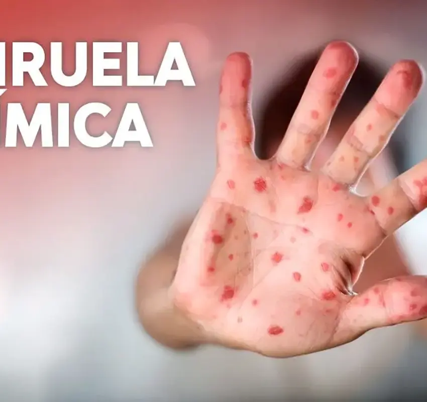 Viruela símica en México: aumento de contagios y vigilancia en CDMX